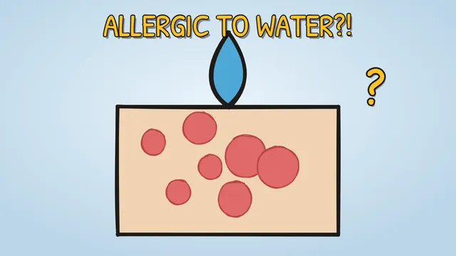 Munchrd: Why are a few people genuinely allergic to water?